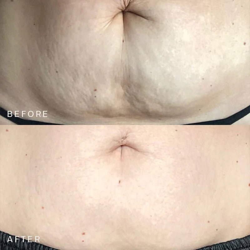 HISKIN - 2 Patch adesivi riutilizzabili per trattamento naturale anti - smagliature - Himama Store